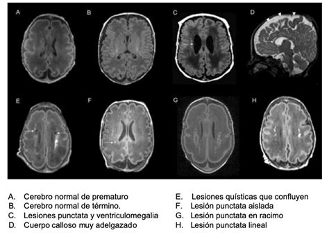 C Mo Se Detectan Las Lesiones De La Sustancia Blanca Del Prematuro