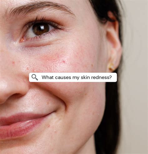 Causes Of Skin Redness And What Skincare Can And Cant Do To Help