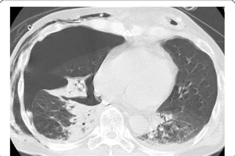 Chest Ct Scan Right Advanced Pneumothorax And Left Atelectasis And