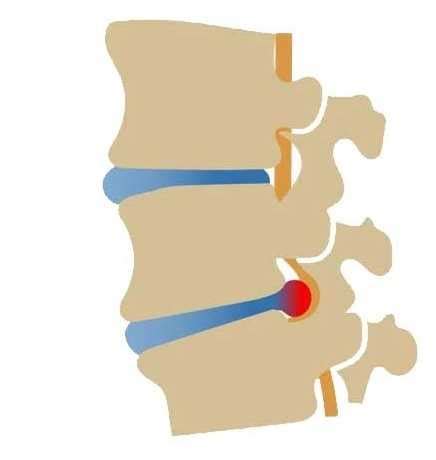 Soulager la Hernie Discale Lombaire L4L5 ou Lombo sacrée L5S1