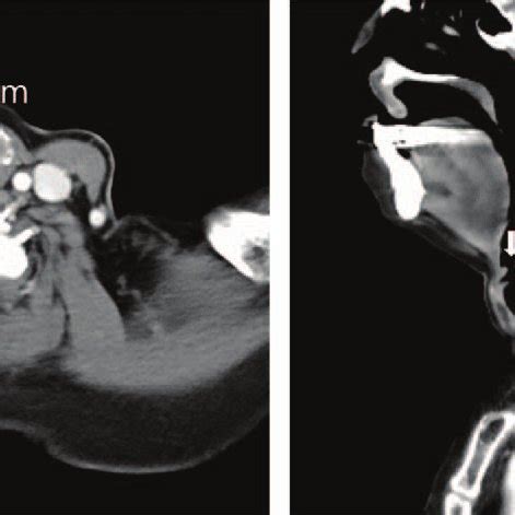 Preoperative Axial Computed Tomography View Left Arrow And Sagittal