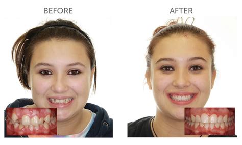 Invisalign Invisible Braces Essex Hornchurch Invisalign Dentist