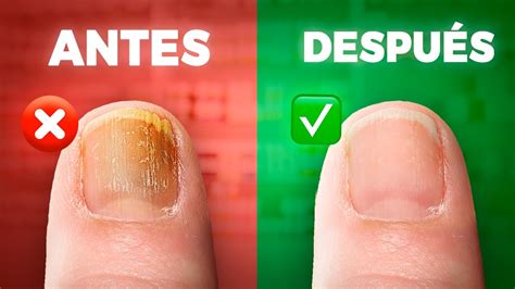 ¿hongos En Las UÑas Onicomicosis Diagnóstico Y Tratamiento Correcto