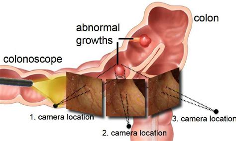 D Reconstruction Of An Abnormal Polyp From Three Colonoscopy Images Download Scientific Diagram