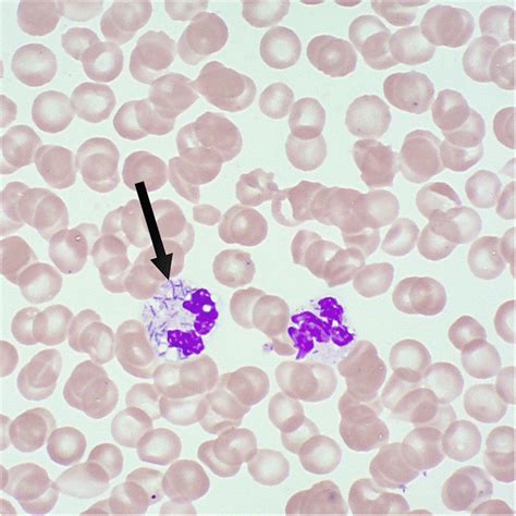 Peripheral Blood Smear With May Grünwald Giemsa Stain Download