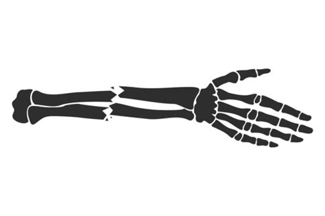 Broken Hand Bones. Bone Fracture. Injury Graphic by microvectorone ...