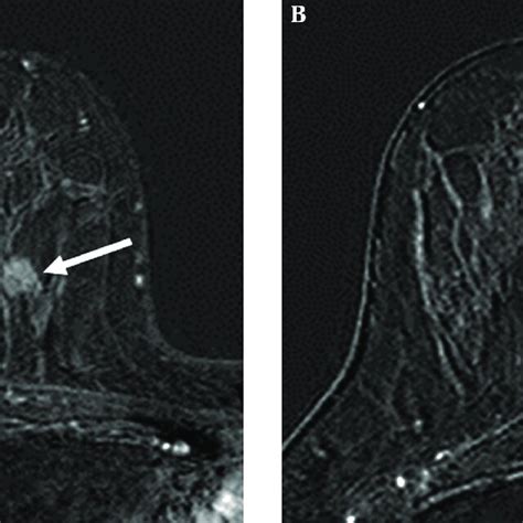 A 52 Year Old Woman With A Invasive Ductal Carcinoma In The Upper