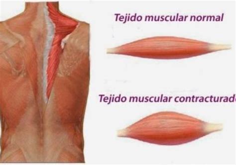 C Mo Quitar Nudos Musculares O Contracturas Desde Casa Y Sin Ayuda