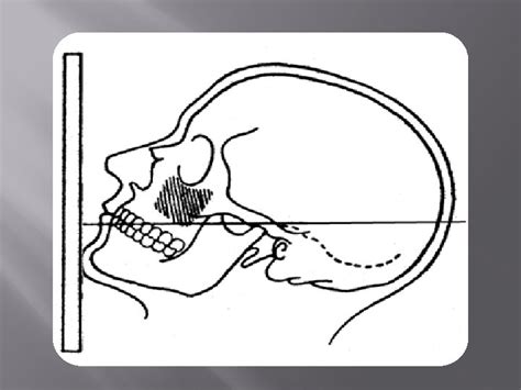 Extraoral Radiographic Technique Extraoral Radiograph Is Defined As