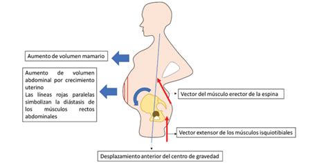 Dolor De Espalda En El Embarazo Acunar