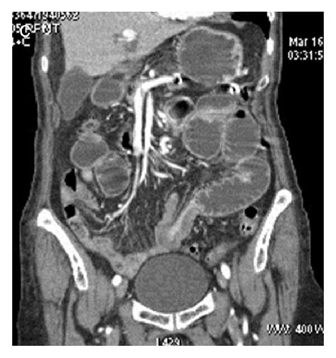 Enteroenteric Ileoileal Intussusception Bowel Wall Of Download Scientific Diagram