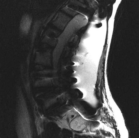 Surgical Management Of Cerebrospinal Fluid Leakage After Spinal Surgery