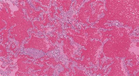 Cavernous Hemangioma In The Liver Ottawa Atlas Of Pathology