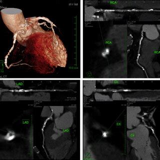 Representative Multidetector Computed Tomographic Coronary Angiographic