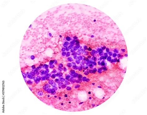 Photomicrograph Of Fine Needle Aspiration Fna Cytology Of A Pulmonary