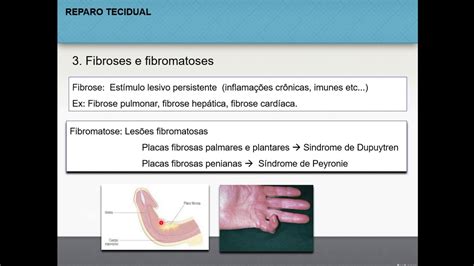 Reparo Tecidual Patologia Geral Youtube