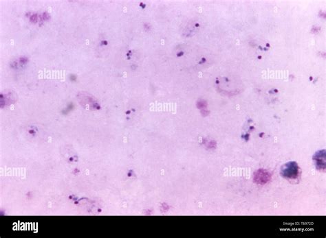 Tinción De Giemsa Microfotografía De Película Gruesa De Plasmodium Vivax Anillos Y Un Viejo