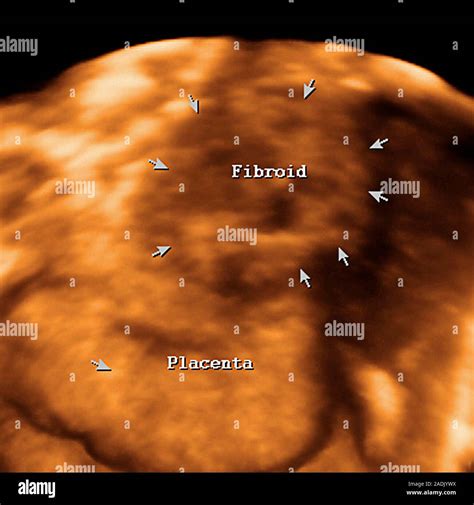 Fibroma Uterino Durante El Embarazo D De Color Ultrasonido De Un