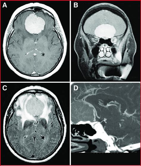 Preoperative Imaging Of An Olfactory Groove Meningioma A And B