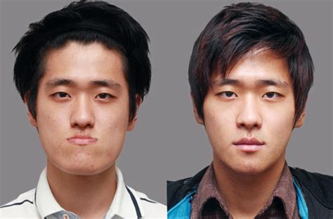 South Korean Plastic Surgery Before And After