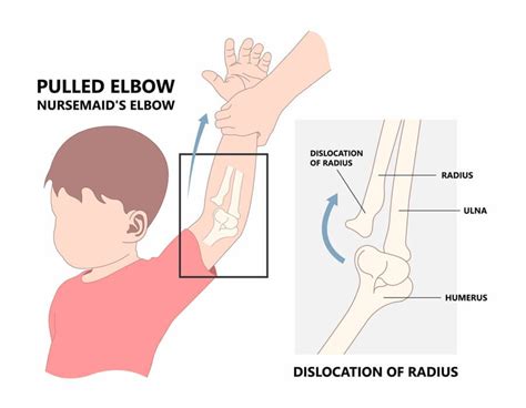 Elbow Pull - OrthoVision Clinic