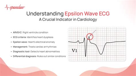 Epsilon Wave ECG: Understanding and Overview