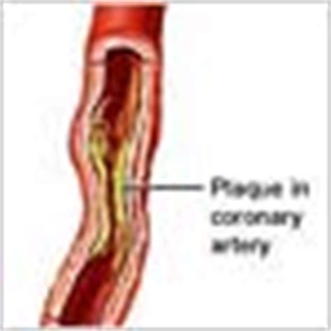 Coronary Artery Spasm - Symptoms, Diagnosis, Treatment of Coronary ...