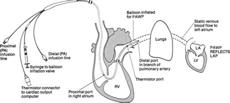 73 Pulmonary Artery Catheter Insertion Assist And Pressure Monitoring Anesthesia Key