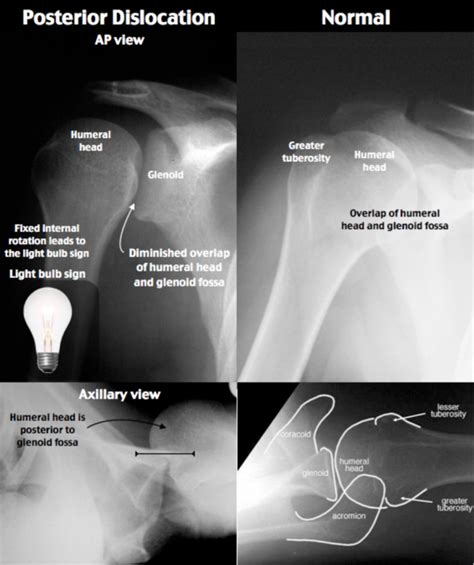 emDOCs.net – Emergency Medicine EducationEM@3AM: Posterior Shoulder Dislocation - emDOCs.net ...