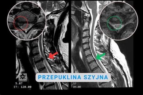 Jak Rehabilitowa Przepuklin Szyjn Kr Gos Upa Rehmedis Pl