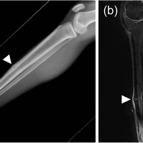 Medial Tibial Stress Syndrome Evaluated As Grade 4b In The Fredericson Download Scientific