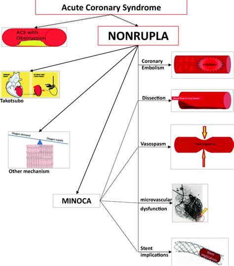 Mechanisms of non-obstructive acute coronary syndromes. NONRUPLA, acute ...