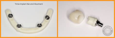 Trinia Metal Free Implant Bar And Abutment Iverson Dental Labs