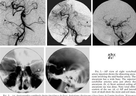 Figure From Endovascular Treatment Of Ruptured Posterior Circulation