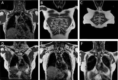 Pdf Abbreviated Mri For Comprehensive Regional Lymph Node Staging