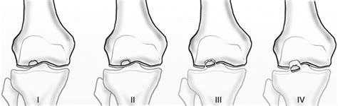 Osteochondritis Dissecans Cause Symptoms Treatment Exercise