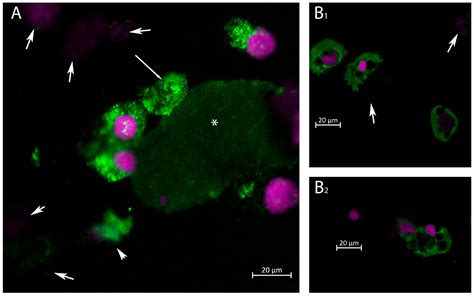 Ijms Free Full Text Acute Kidney Injury And Bk Polyomavirus In