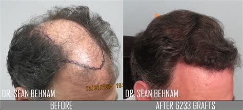 Fue Hair Transplant Los Angeles Dr Sean Behnam