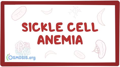 Sickle Cell Anemia Causes Symptoms Diagnosis Treatment And Pathology