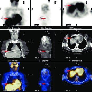 Pdf Incidental Breast Lesion Detected By Technetium M Sestamibi