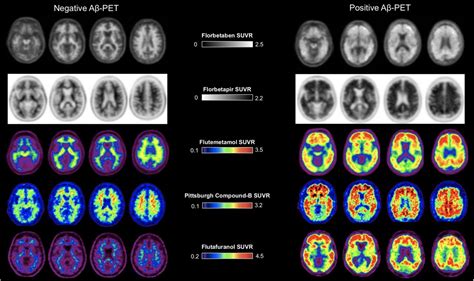 The Role Of Amyloid Pet In Imaging Neurodegenerative Disorders A