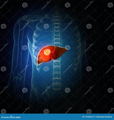 Liver Cancer Stock Illustration Illustration Of Health 127826315