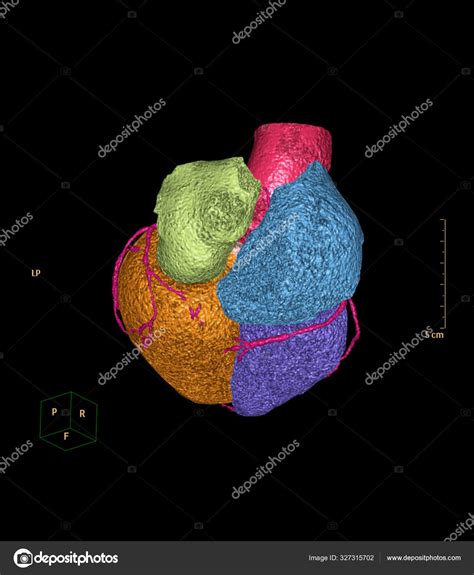 cta coronary artery rendering image detect coronary artery disease