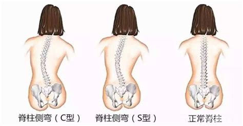 快来测一测！专家教你4个方法鉴别孩子有没有脊柱侧弯家长