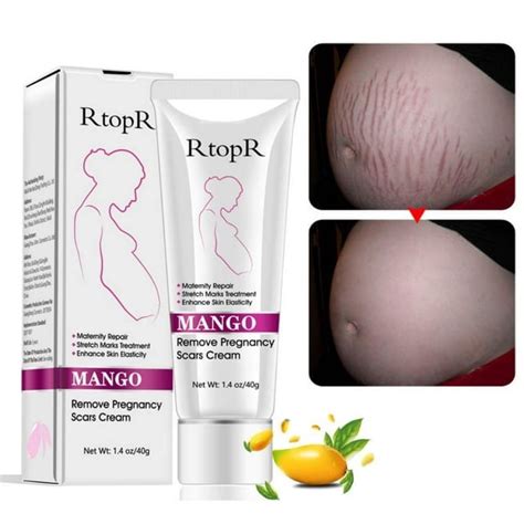 RtopR Mango Stretch Marks And Scar Cream Stretch Marks And Scar