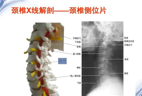 颈椎x线诊断的内容及其解读 好医术早读文章 好医术 赋能医生守护生命