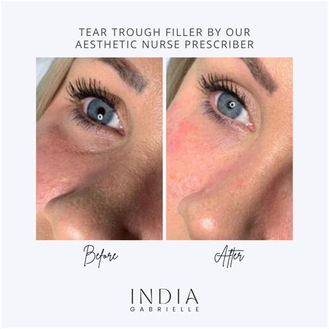 Tear Trough Filler India Gabrielle Elite Permanent Makeup Artist