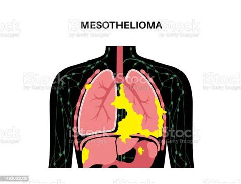 Mesothelioma Cancer Disease Stock Illustration Download Image Now