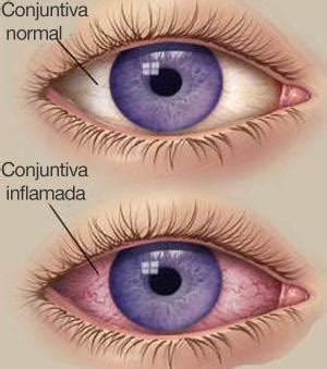 Conjuntivitis alérgica Enciclopedia Médica Ferato