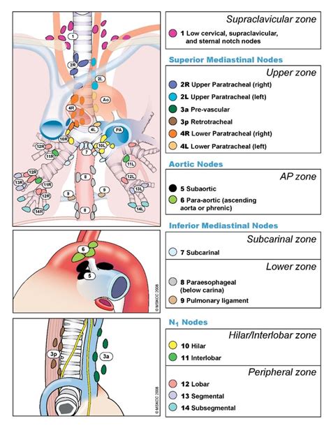 Stage 2 Cancer Lymph Nodes